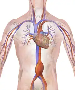 Abdominal aortic aneurysm.