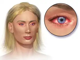 Allergic conjunctivitis.